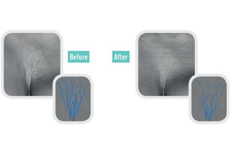 Before/After Gatuline In Tense
