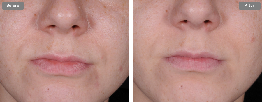 Before/After Cytobiol Iris A