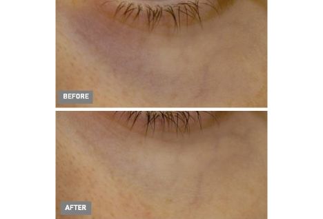 before after picture Cytobiol Lumin Eye