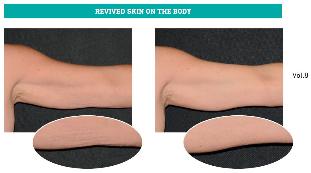 Pictures energinius before-after on arms