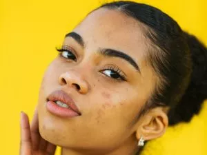 anti-acne